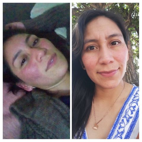 tutare testimonio rosacea