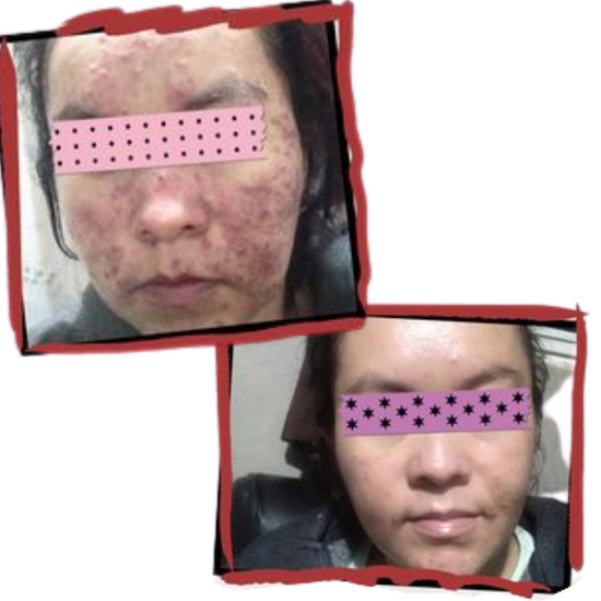 tutare testimonio rosacea